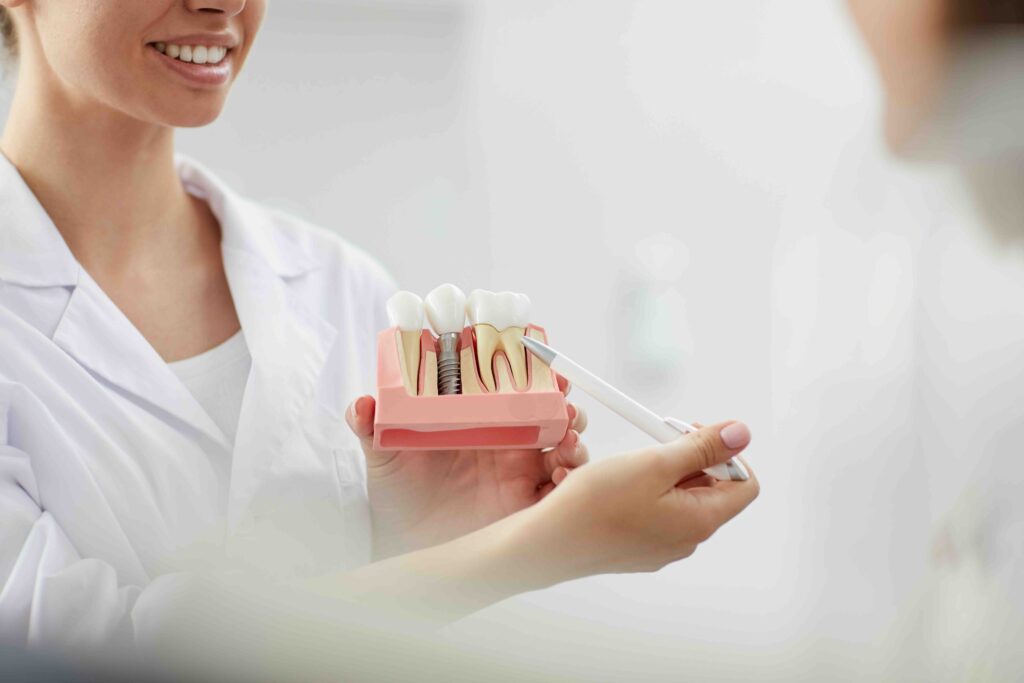 dental implants step by step - Come funziona impianto dentale