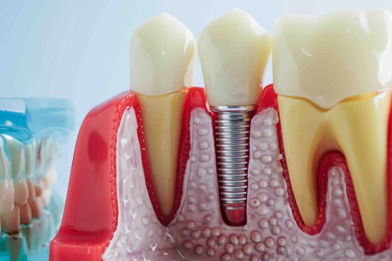 How a Dental Implant Works